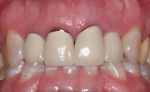 Bọc răng sứ kim loại có tốt không?